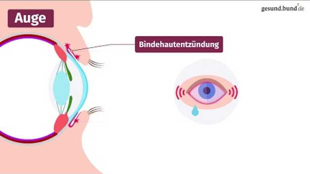 Video Was ist eine Bindehautentzündung? po polsku