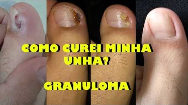 Video COMO SAREI MINHA UNHA ENCRAVADA? GRANULOMA - Ramon Carvalho in English