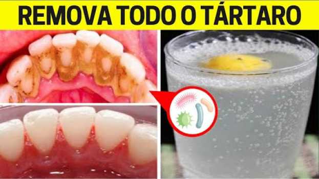 Video Basta Só Isto Nos DENTES Para REMOVER O TÁRTARO Sem Gastar Quase Nada ! en español