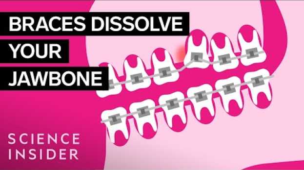 Video How Do Braces Actually Work? auf Deutsch