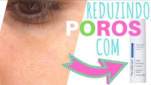 Video POROS DILATADOS - TEM SOLUÇÃO COM ÁCIDO GLICÓLICO? | Iruama en español