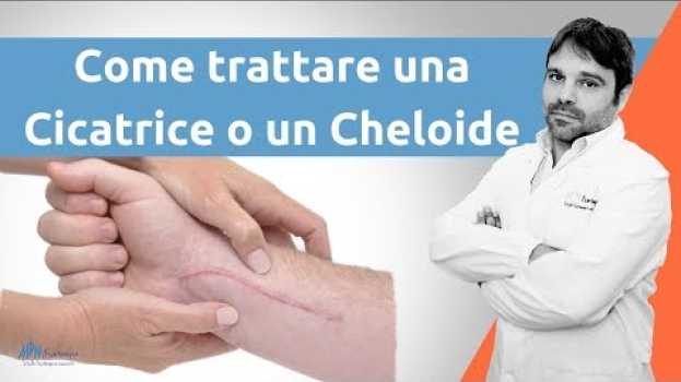 Video Come trattare una cicatrice cheloide auf Deutsch
