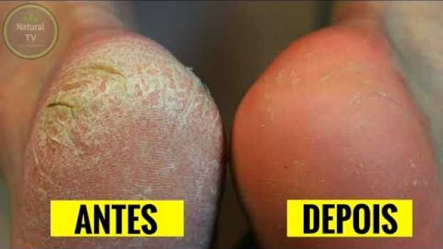 Video Basta Fazer Isso Para Tirar Todas as RACHADURA DOS PÉS em 5 Dias ou Menos ! po polsku