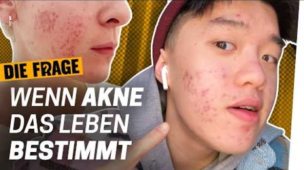 Video Akne: Mehr als nur Pickel | Wie komme ich mit meinem Körper klar? Folge 5   türkçe
