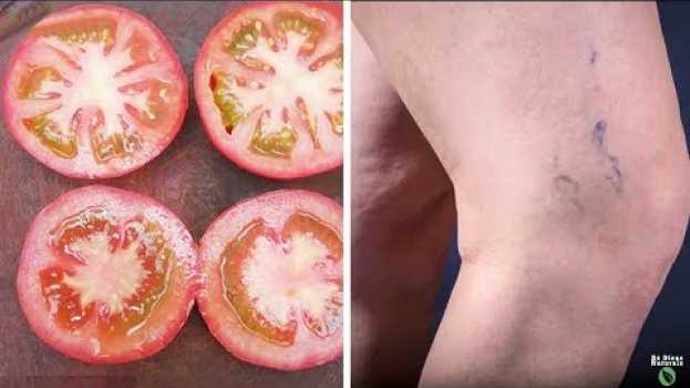 Video 🍅Eu Tinha Minhas Pernas Cheias De Varizes E Um Médico Me Deu Esse Truque Caseiro in English