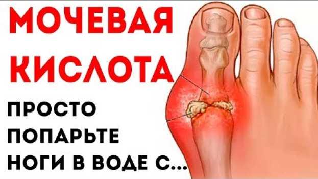 Video Мочевая кислота нормализуется, а подагра уменьшится, если выпить стакан отвара из обычной... en français
