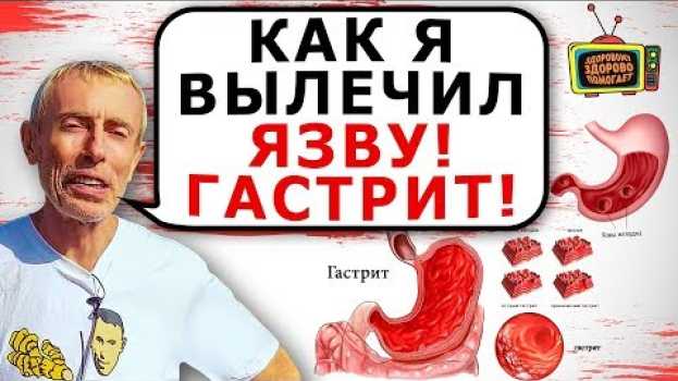Video КАК Я ВЫЛЕЧИЛ ЯЗВУ, ГАСТРИТ! Островский. Что делать, если гастрит, язва желудка. Ответы на вопросы in English