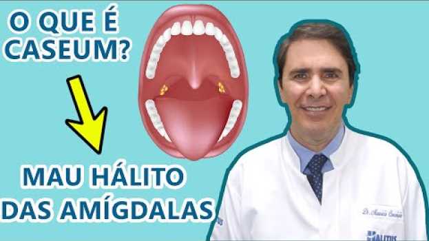 Video Caseum ou Bolinhas na Garganta | Mau hálito das Amígdalas auf Deutsch