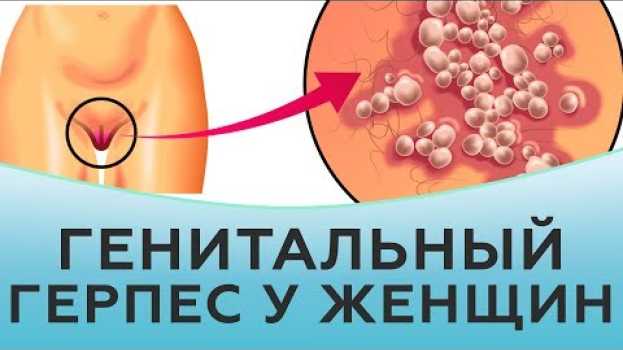 Video Генитальный герпес у женщин in English