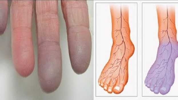 Video Cattiva circolazione nelle gambe? Questi rimedi casalinghi naturali aiutano!   türkçe