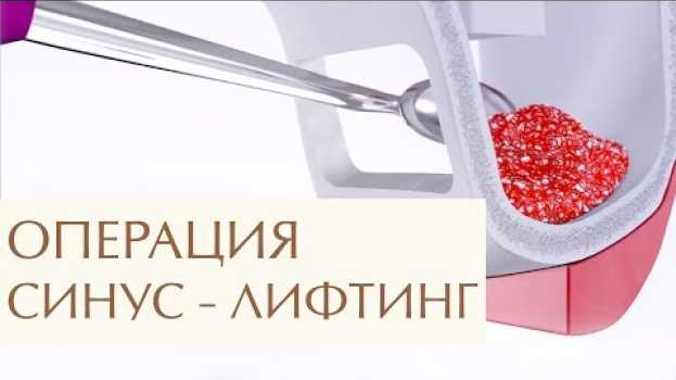 Video 👉 Способы наращивания костной ткани для имплантации. Наращивание костной ткани для имплантации. 12+ en français
