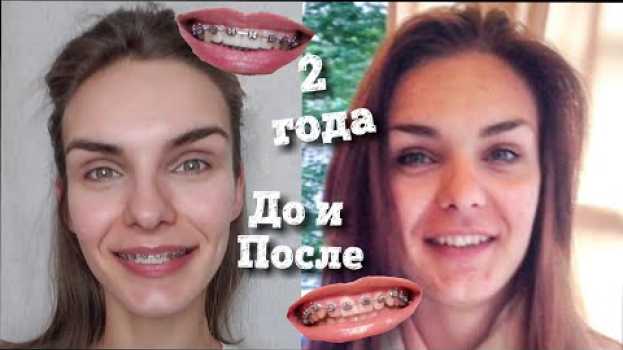 Video Брекеты 2 года | До и После | Как прикус меняет лицо | em português