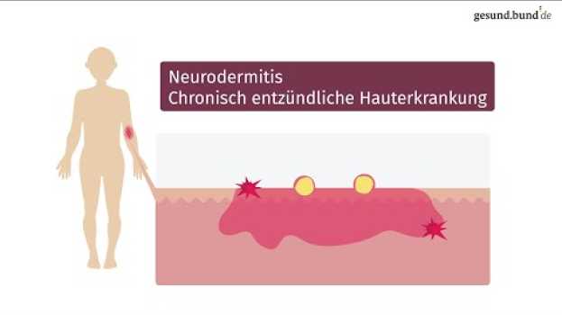 Video Was ist Neurodermitis und wie kann man sie behandeln? en español