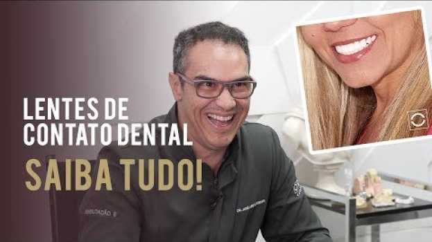 Video Lentes de contato dental, tudo o que você precisa saber! - Estética Oral   türkçe