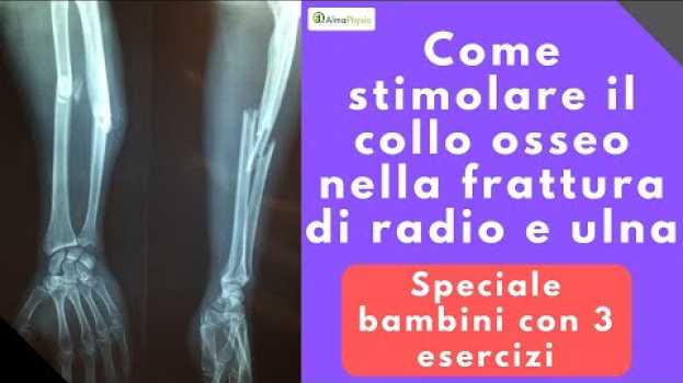 Video Come stimolare il callo osseo nella frattura di radio e ulna (speciale bambini con 3 esercizi!!) po polsku