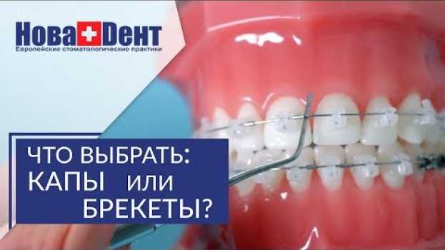 Video Брекеты или капы. ❓ Какой вариант лечения выбрать — брекеты  или капы. НоваДент. 12+ auf Deutsch