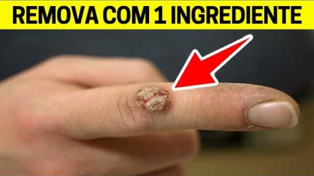 Video Elimine Todas as VERRUGAS da Pele em 1 Semana, Basta Usar Isso | Receita Caseira   türkçe