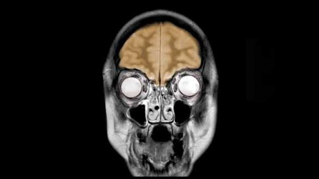 Video A Dad Drank 50 Beers Everyday For 6 Weeks. This Is What Happened To His Brain. en español