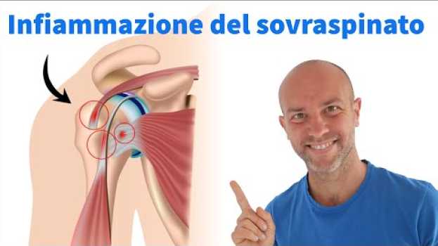 Video Risolvi l'infiammazione del SOVRASPINATO con questi semplici esercizi em português