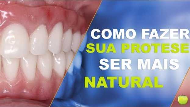 Video Como Fazer a Prótese com Implantes parecer Natural in English