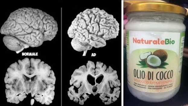 Video Un Uomo Ha Assunto Olio Di Cocco 2 Volte Al Giorno Per 2 Mesi E Il Suo Cervello È Cambiato! in English