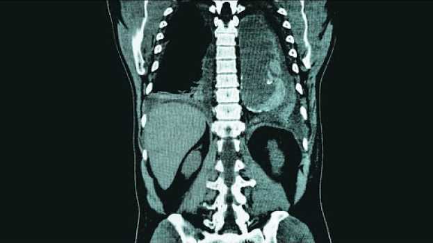 Video A TikToker Drank 2 Bottles Benadryl. This Is What Happened To Her Organs. su italiano