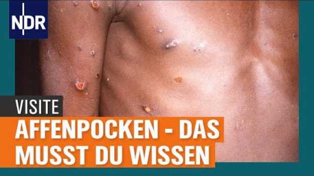 Видео Affenpocken: Wie gefährlich ist das Virus und wie wird es übertragen? | Visite | NDR на русском