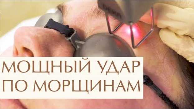 Video 💆  Что такое лазерное омоложение лица, этапы процедуры. Лазерное омоложение лица что это. 12+ in English