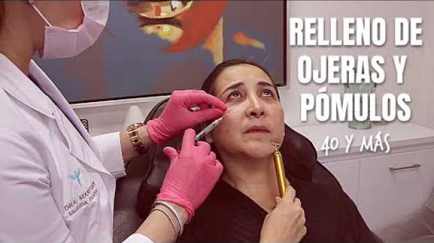 Видео Relleno de Ojeras y Pómulos con ácido hialurónico | Mujeres de 40 años y más на русском