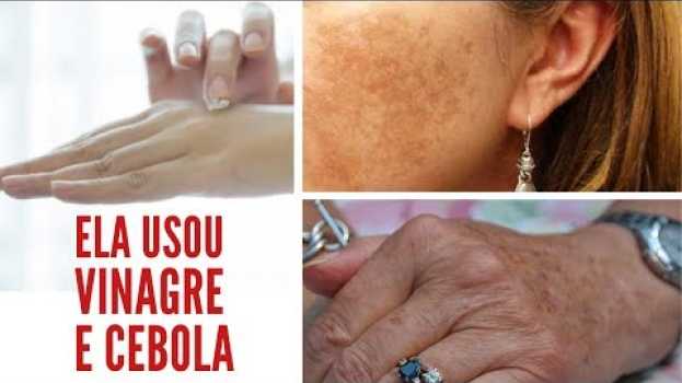 Video Ela usou cebola e vinagre de maça, manchas de acne, melasma, de fígado, envelhecimento sumiram! auf Deutsch