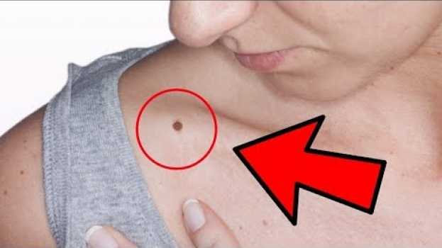 Video Se hai un neo su una precisa parte del corpo, ha un significato sorprendente auf Deutsch