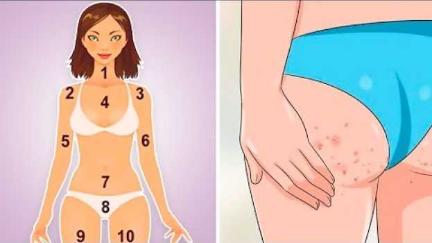 Video O Local da Acne pode te Dizer Muito Sobre sua Saúde, Veja!   türkçe