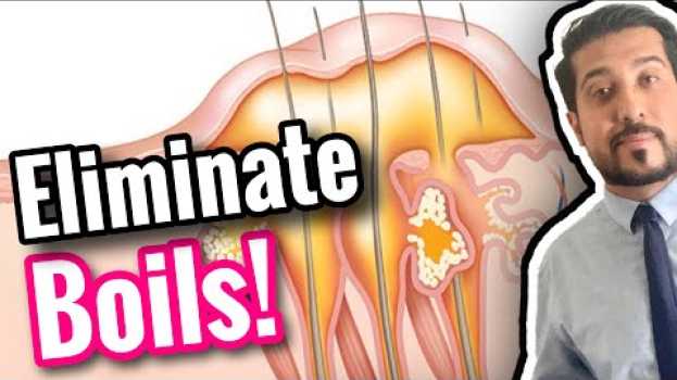 Video 5 Quick Ways to GET RID OF Boils on Skin | How to Treat a Boil Fast in English