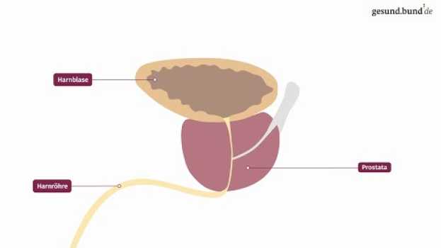 Video Was ist eine Prostatavergrößerung? in English