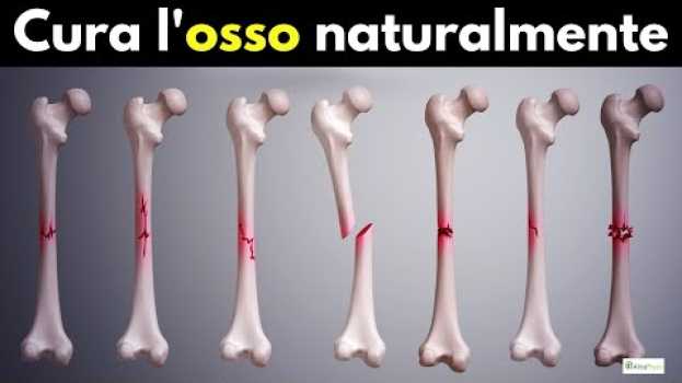 Video Come stimolare il callo osseo (per frattura non consolidata!) in English