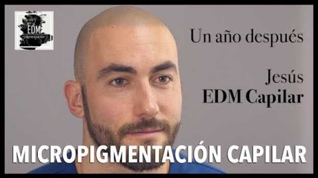 Video Resultados de la micropigmentación capilar de Jesús un año después de terminar el tratamiento   türkçe