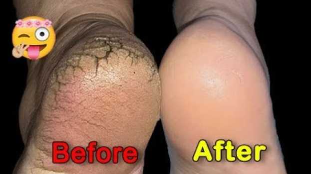Video 👣ПЕДИКЮР Пошагово. ТРЕЩИНЫ НА ПЯТКАХ. Классический педикюр ДОМА. DIY Pedicure at Home.DEEP FOOT CORN en español