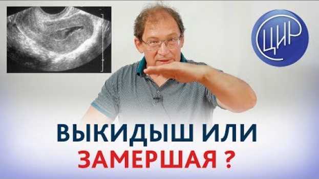 Video Выкидыш или замершая беременность? Чем отличается замершая беременность от выкидыша. Гузов И.И.   türkçe