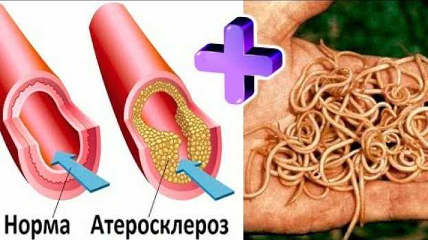 Video Простое, но ЛЮТОЕ НАРОДНОЕ СРЕДСТВО от паразитов, атеросклероза, токсинов и... 🌳 Здоровье po polsku