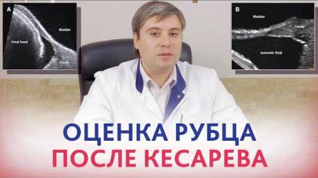 Video Рубец после кесарева. Ультразвуковая оценка рубца на матке после кесарева сечения.  Курганников А.С. em português