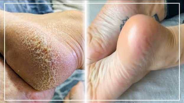 Video TRANSFORMER DES PIEDS TRÈS SECS EN PIEDS DE BÉBÉ em português