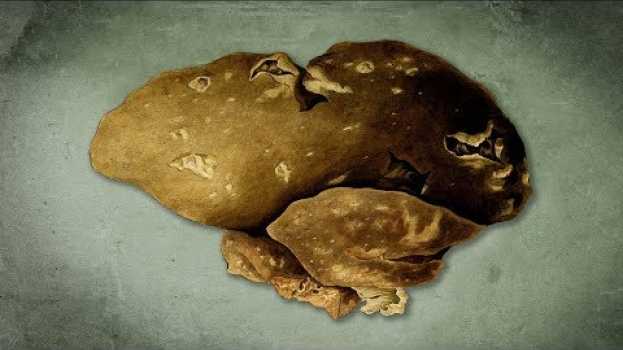 Video A Student Ate Leftover Potato Salad For Lunch. This Is What Happened To Her Liver.   türkçe