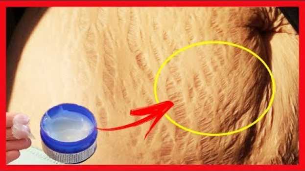 Video ESTO ES SORPRENDENTE El Vick Vaporub Sirve Para Eliminar Todo Tipo de ESTRÍAS en 1 Seman em português