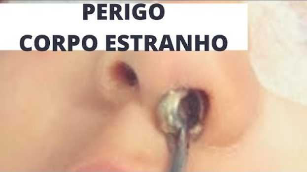 Video PERIGO de uma criança colocar algo no nariz e ouvido/ Dr. Paulo Mendes Jr - Otorrino em Curitiba en español