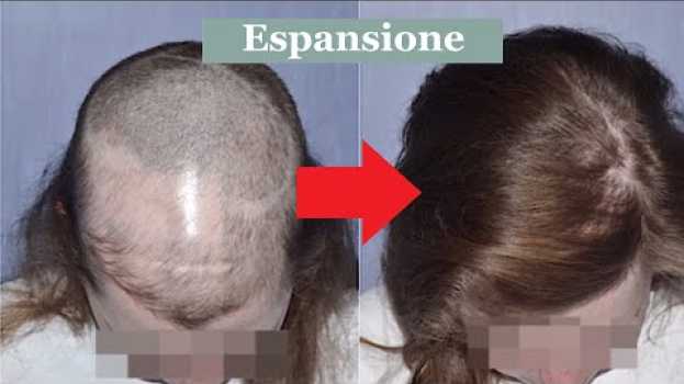 Video Cicatrici del cuoio capelluto ed alopecie: trapianto ed espansione cutanea in English
