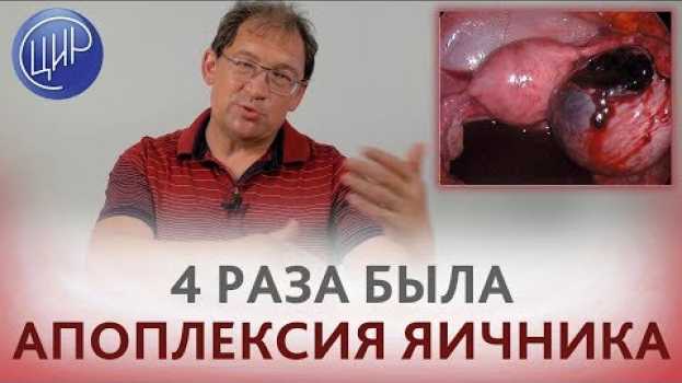 Video Апоплексия яичника. Почему возникает и что делать, если 4 раза была апоплексия яичника em português