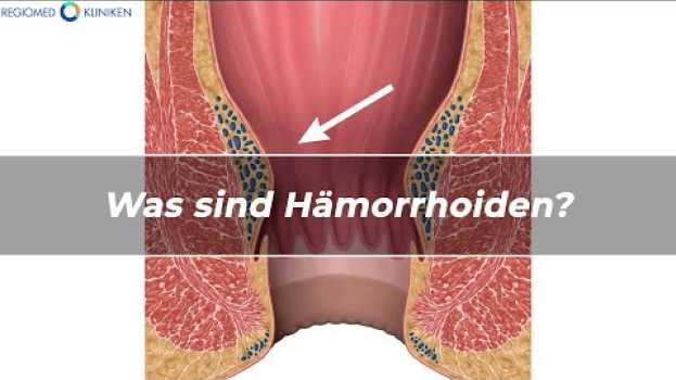 Video REGIOMED Kliniken: Was sind Hämorrhoiden, Hämorrhoiden erkennen, Blut im Stuhl   türkçe