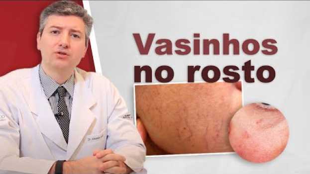 Video Vasinhos no rosto.Tem como tratar. Laser é melhor.   türkçe