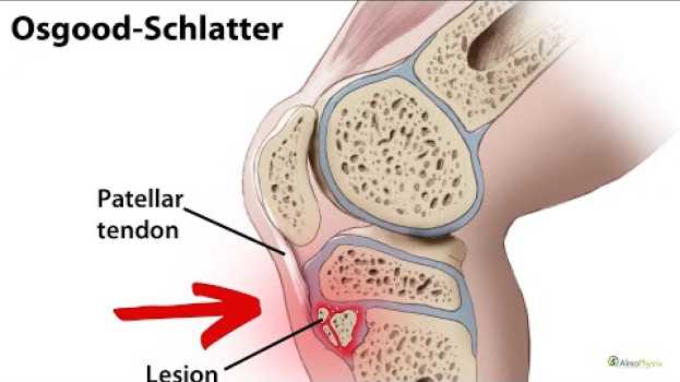Video Osgood–Schlatter cure ed esercizi auf Deutsch