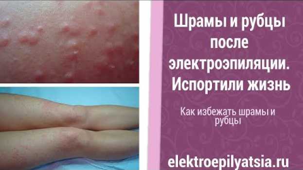 Video Как избежать Шрамы и рубцы после электроэпиляции. Испортили жизнь su italiano